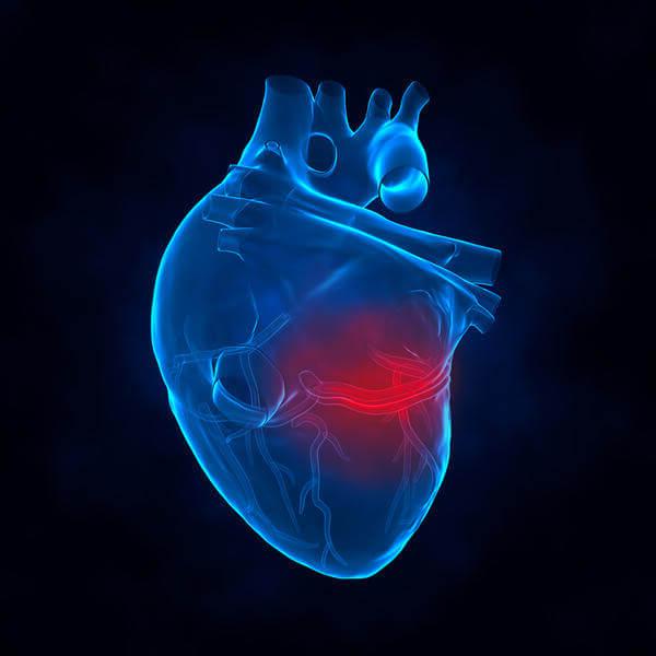 heart illustration - myocardial infarction treatment