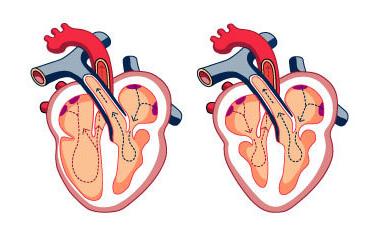 congestive heart failure symptoms and diagnosis: congestive heart failure illustration
