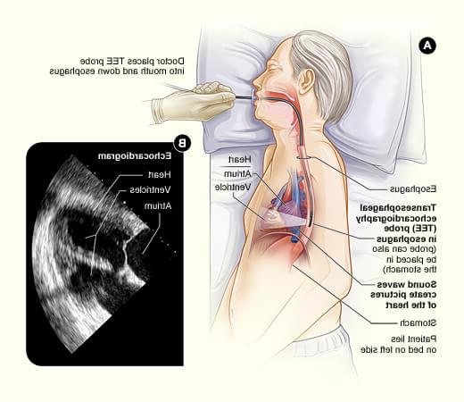 transesophageal echocardiogram procedure illustration